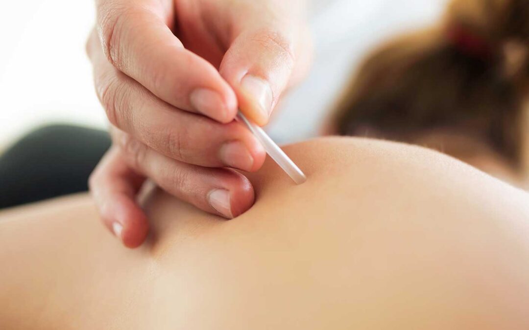 Dry Needling als extra ondersteuning tijdens een fysiotherapeutische behandeling
